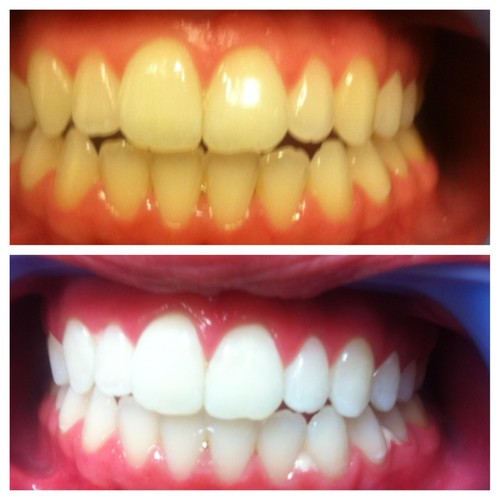 Strisce sbiancanti denti pap - sbiancanti,